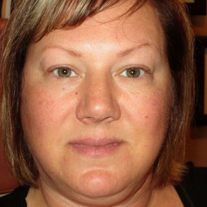 Permanent MakeUp Case 42 - Before