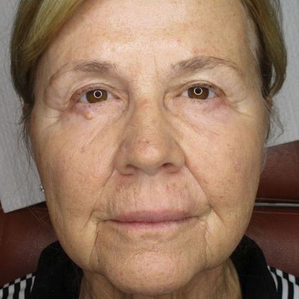 Permanent MakeUp Before and After - Before