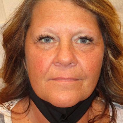 Permanent MakeUp Case 43 - Before