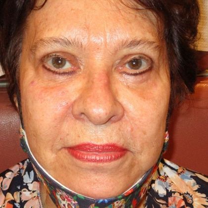 Permanent MakeUp Case 44 - Before