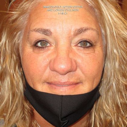 Permanent MakeUp Case 45 - After