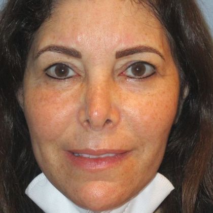 Permanent MakeUp Case 47 - After