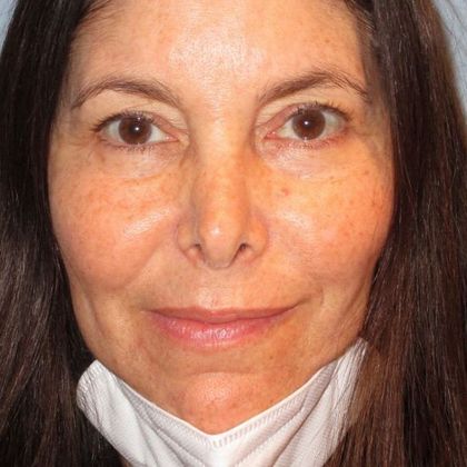 Permanent MakeUp Case 47 - Before