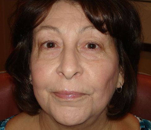 Permanent MakeUp Case 48 - Before