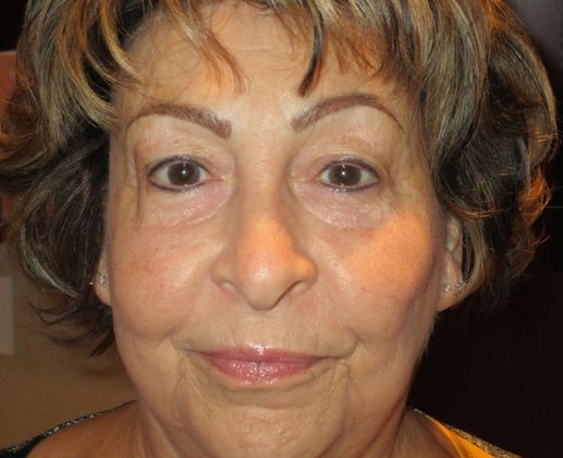 Permanent MakeUp Case 48 - After