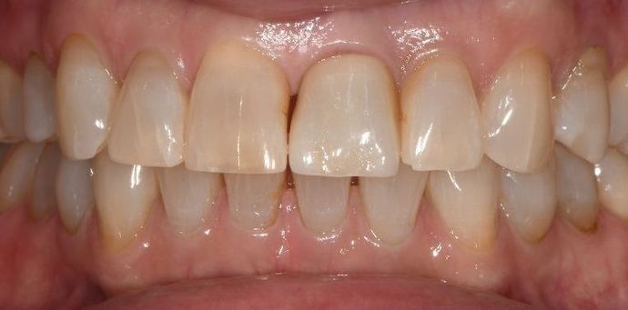 Dental Implants Case 8 - Seadrift, TX - After