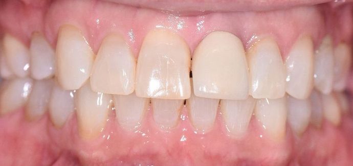 Dental Implants Case 8 - Seadrift, TX - Before