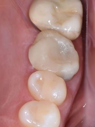 Crowns Case 12 - Ganado, TX - Before