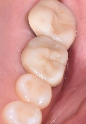 Crowns Case 12 - Ganado, TX - After