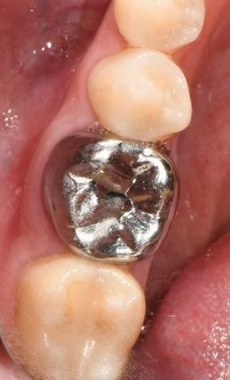 Crowns: Case 13 - Edna, TX - Before