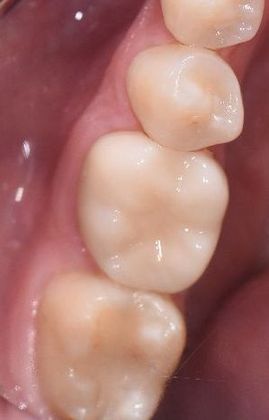 Crowns: Case 13 - Edna, TX - After