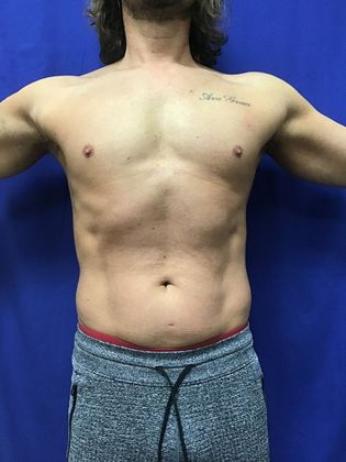 Cooltone Muscle Stimulation: Case 4 - 4) After, final result