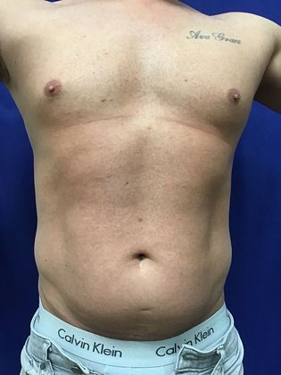 Cooltone Muscle Stimulation: Case 4 - 1) Before