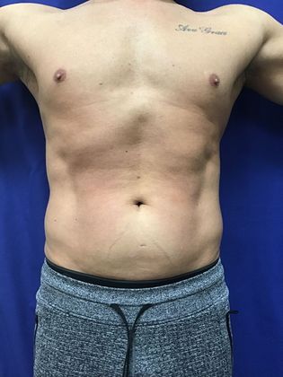 Cooltone Muscle Stimulation: Case 4 - 2) After weight loss