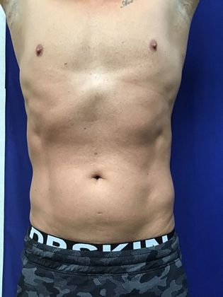 Cooltone Muscle Stimulation: Case 4 - 3) After initial Cooltone treatments