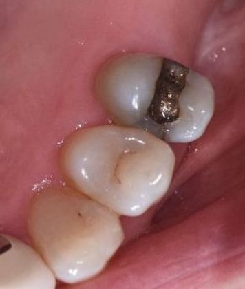 Crowns Case 14 - Victoria, TX - Before