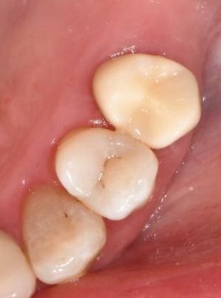 Crowns Case 14 - Victoria, TX - After