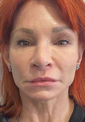 Facelift: Case 17 Face and Neck Lift, Rowayton, CT - Before