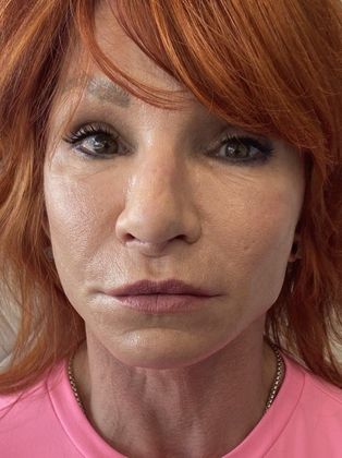 Facelift: Case 17 Face and Neck Lift, Rowayton, CT - After