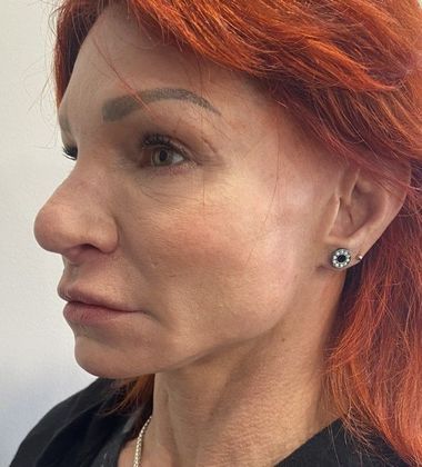 Facelift: Case 17 Face and Neck Lift, Rowayton, CT - Before