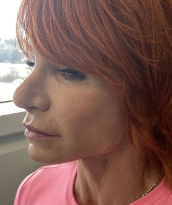 Facelift: Case 17 Face and Neck Lift, Rowayton, CT - After