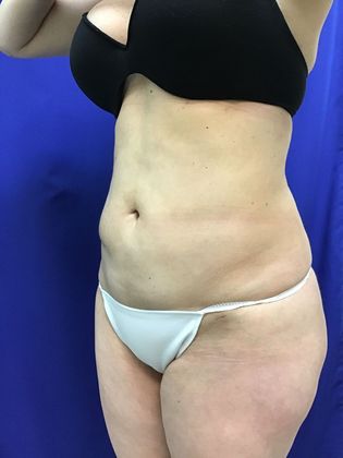 Body Buttock Enhancement: Case 4 (30104) - After