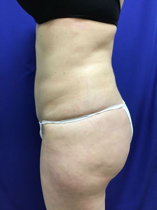 Body Buttock Enhancement Case 4 (30104) - After