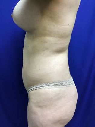 Body Buttock Enhancement Case 4 (30104) - Before