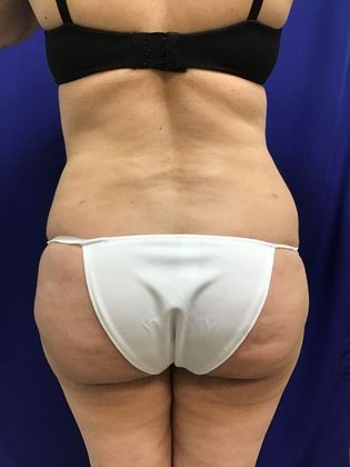 Body Buttock Enhancement: Case 4 (30104) - Before