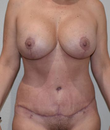 Mommy Makeover Case 183 - After