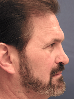 Nose Reshaping (Rhinoplasty) Case 3- Reconstructive Rhinoplasty (Dr Christopher Hove, Philadelphia