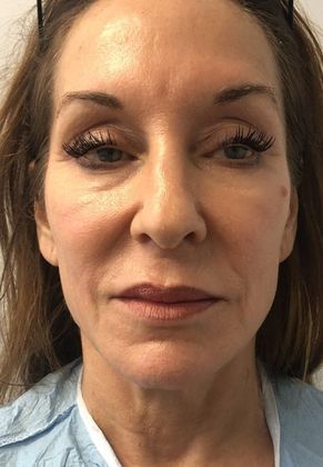 Facelift: Case 27 Facelift Darien - Before