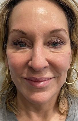 Facelift: Case 27 Facelift Darien - After