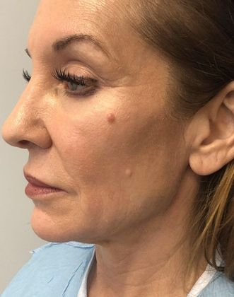 Facelift: Case 27 Facelift Darien - Before