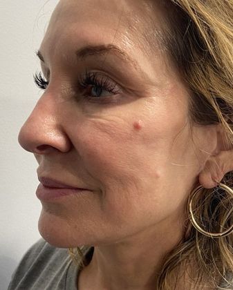 Facelift: Case 27 Facelift Darien - After