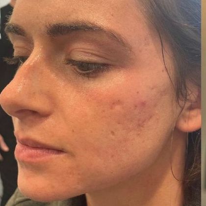 Laser Resurfacing: Case 1 Laser Treatment for Acne scars Norwalk, CT - Before