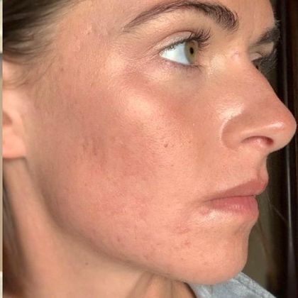 Laser Resurfacing: Case 1 Laser Treatment for Acne scars Norwalk, CT - After
