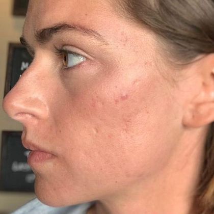 Laser Resurfacing: Case 1 Laser Treatment for Acne scars Norwalk, CT - After