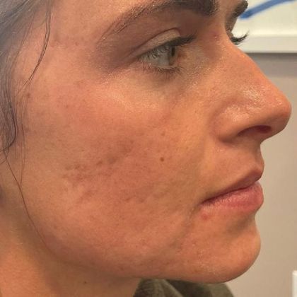 Laser Resurfacing: Case 1 Laser Treatment for Acne scars Norwalk, CT - Before