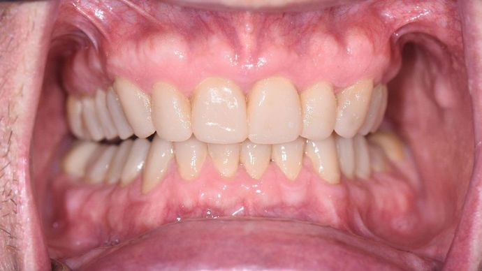 Full Mouth Reconstruction Case 2 - Cuero, TX - After