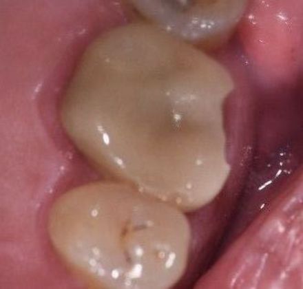 Crowns Case 15 - Victoria, TX - Before