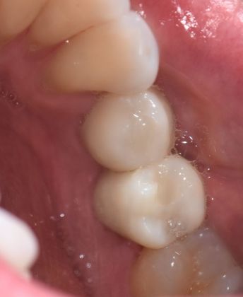 Dental Implants Case 10 - Victoria, TX - After