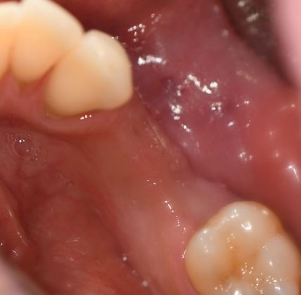 Dental Implants Case 10 - Victoria, TX - Before