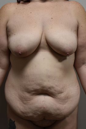 Massive Weight Loss : Case 79 - Before