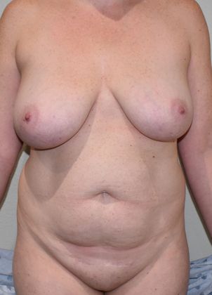 Mommy Makeover Case 185 - Before