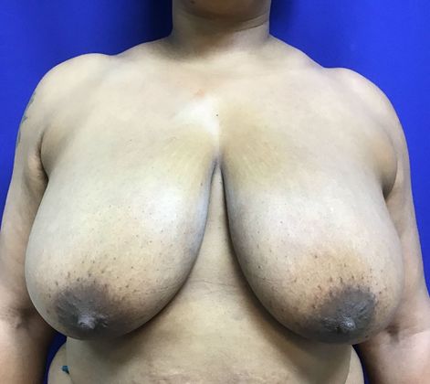 Breast Reduction: Case 33 (30183) - Before
