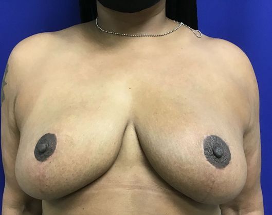 Breast Reduction: Case 33 (30183) - After