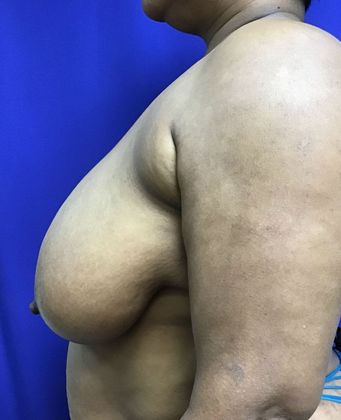 Breast Reduction: Case 33 (30183) - Before