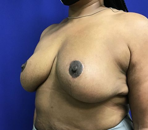 Breast Reduction: Case 33 (30183) - After