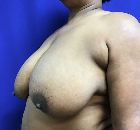 Breast Reduction: Case 33 (30183) - Before
